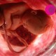 pérdida de liquido, embrion, bebe, utero, precaución, ginecología, Dr. Félix Lugo,